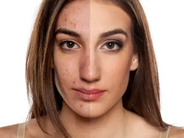 Como se manifesta a acne na mulher adulta?