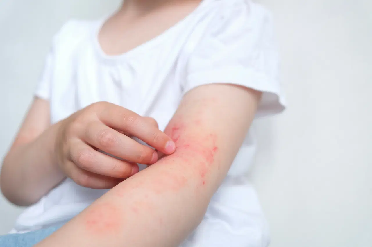 Dermatite Atópica em Bebês: Identificando Gatilhos e Cuidados Adequados