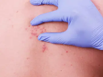 Saiba mais sobre o herpes zoster