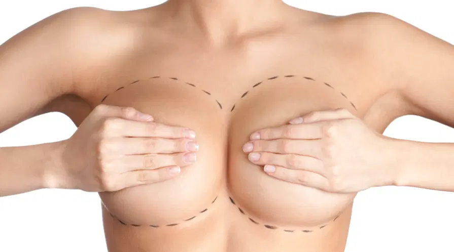 MAMOPLASTIA — Rogério Morale