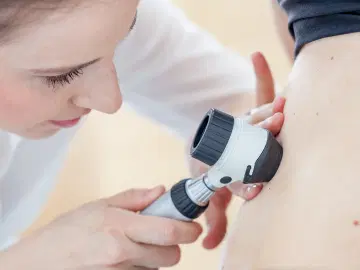 Carcinoma basocelular: o tipo de câncer da pele mais comum em peles claras