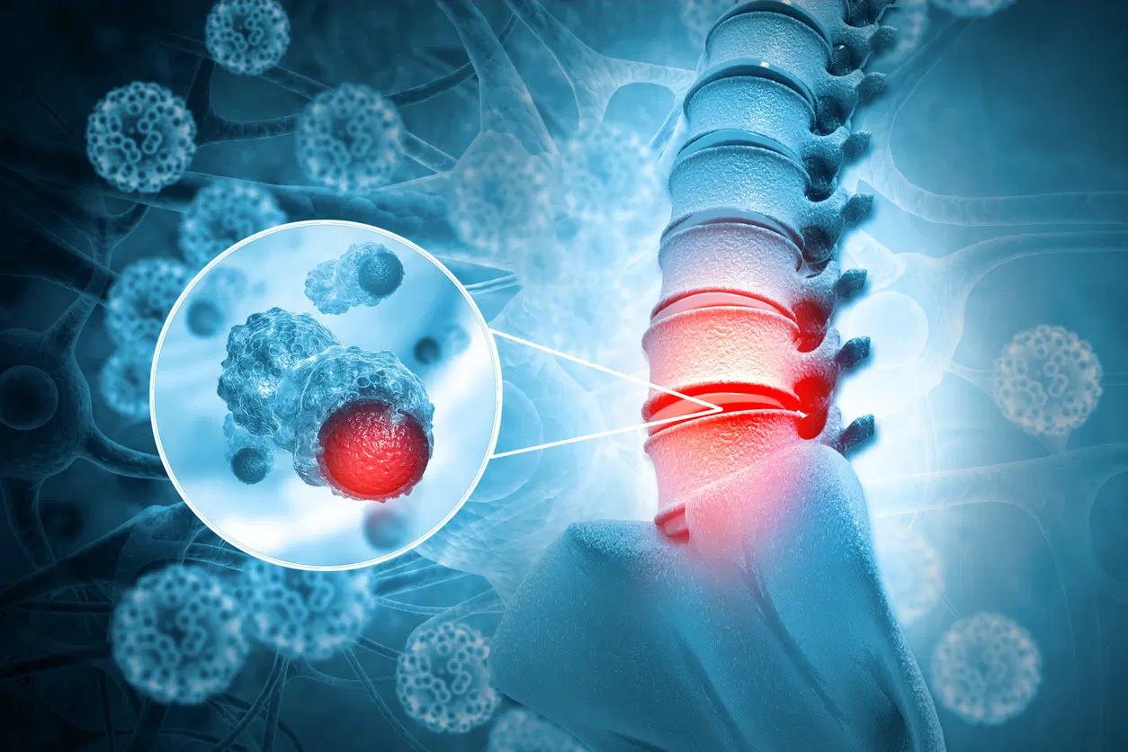 Conheça mais sobre os tumores que surgem na coluna vertebral