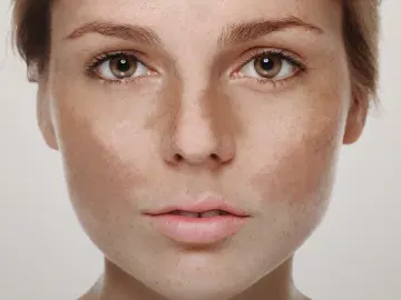 Melasma: as características e as novidades sobre o tema