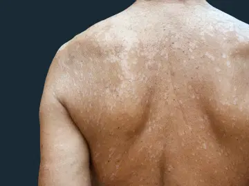 Pitiríase versicolor - aproveite o verão, mas sem micoses!