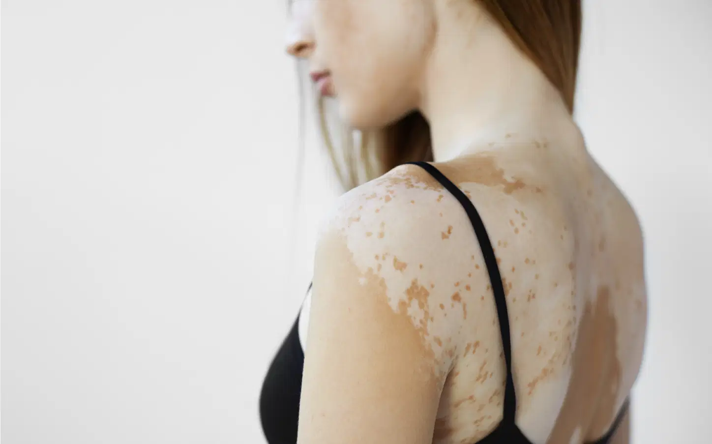 5 pontos importantes sobre o vitiligo