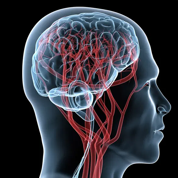 NEUROCIRURGIA VASCULAR