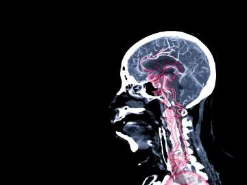Cirurgia para o aneurisma cerebral