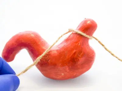 Como é o processo de recuperação da cirurgia bariátrica?