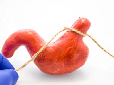 Como é o processo de recuperação da cirurgia bariátrica?
