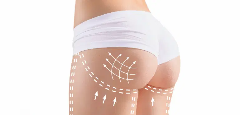 GLUTEOPLASTIA — Rogério Morale