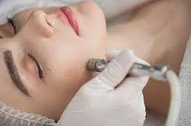 Peeling
