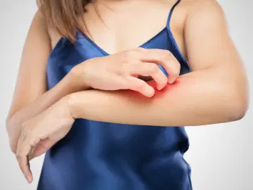 Como evitar as micoses no verão?