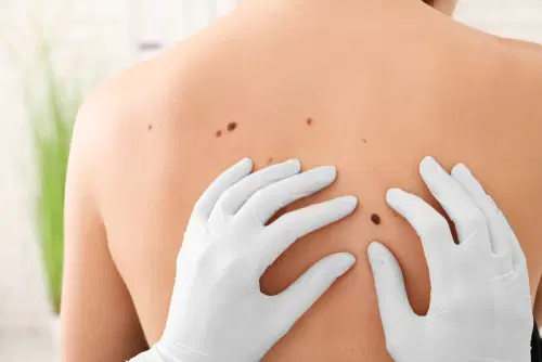 Orientações para cirurgia de Câncer de Pele - Convencional ou Micrográfica de Mohs
