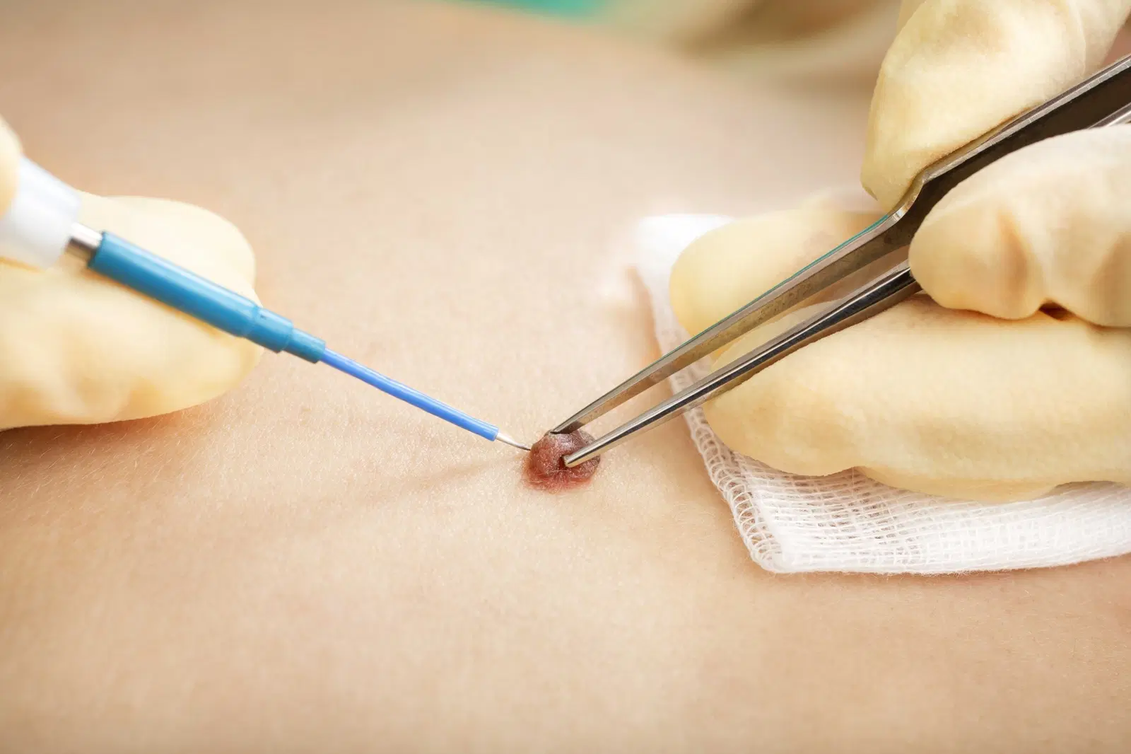 DERMATOLOGIA CIRÚRGICA