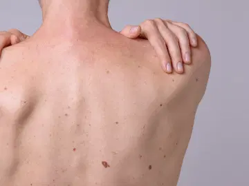 Melanoma tem cura, mas precisa de diagnóstico precoce