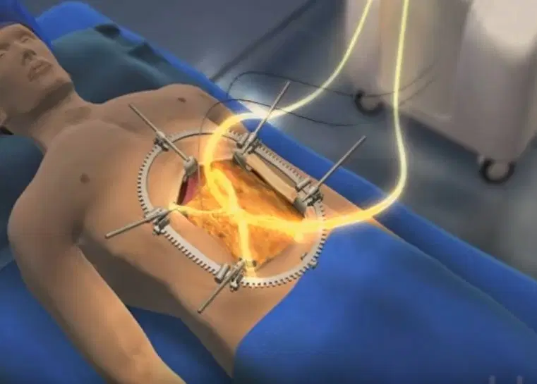HIPEC – Quimioterapia Intraperitoneal Hipertérmica