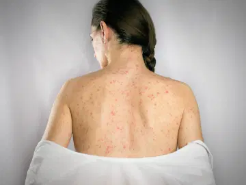 Casos de sarampo no Brasil: saiba como prevenir