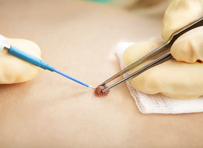 Eletrocirurgia